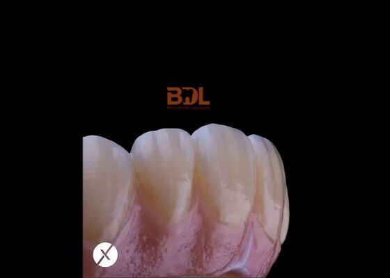 Full Zirconia Ceramic Dentures High Precision Digital Production For Functional Restoration