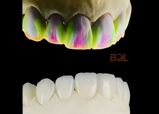 Porcelain Emax Veneers With Cast Porcelain Ultra Thin Handmade Porcelain Stacking