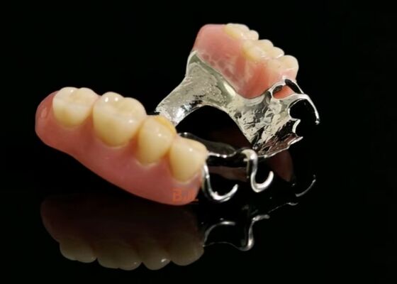 Flexible Metal Partial Denture Removable Dental Prosthesis Designed To Ensure Optimal Fit And Easy Maintenance For Daily